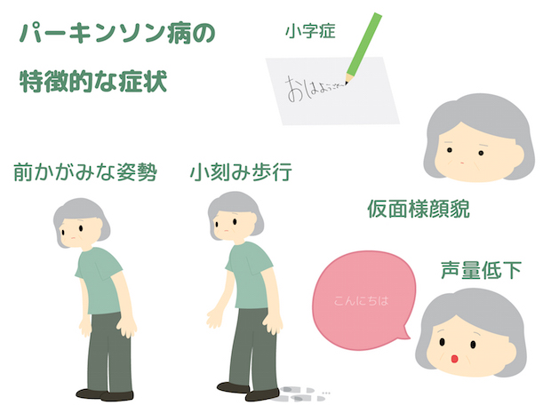 パーキンソン病の特徴的な症状の図
