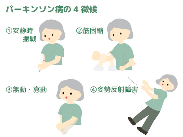 パーキンソン病画像