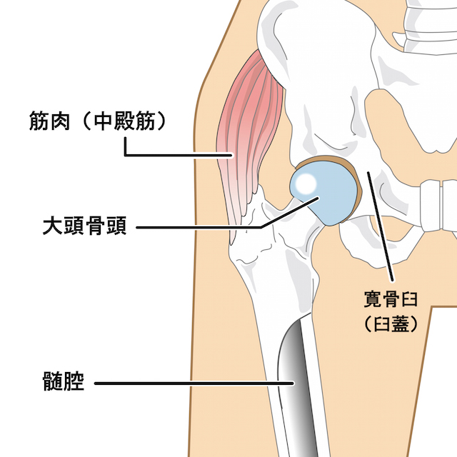 股関節人工関節図解